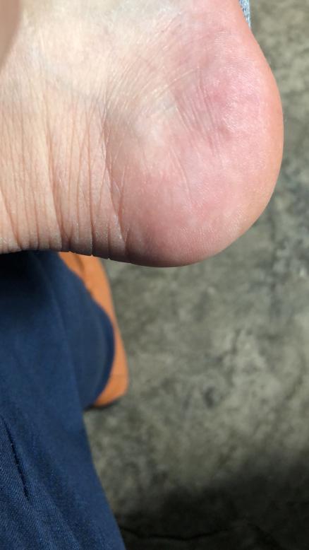 痛风又发作了怎么办3.jpg
